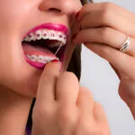 pink color braces
