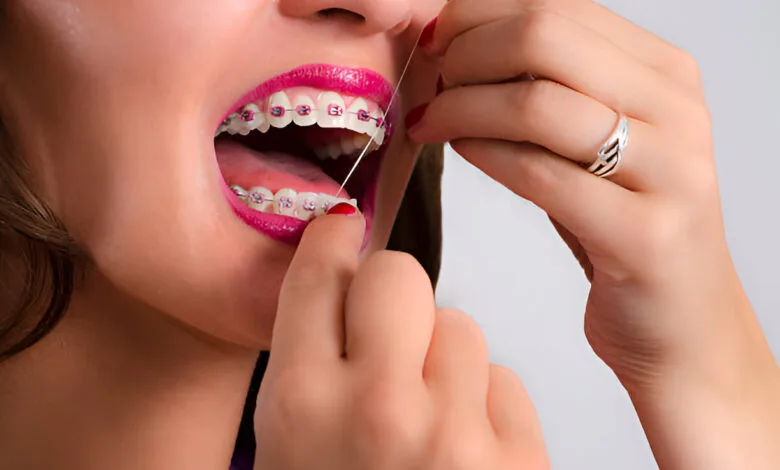pink color braces