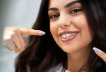 good braces colors