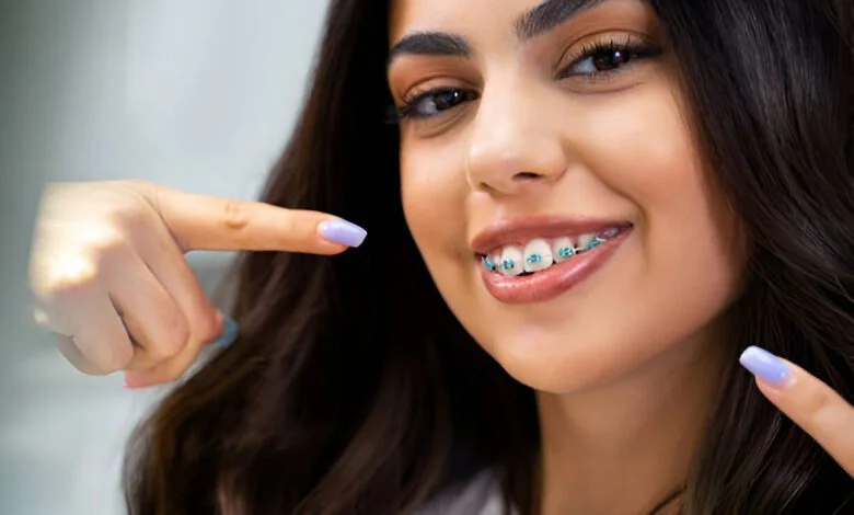 good braces colors