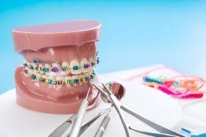 brackets for braces