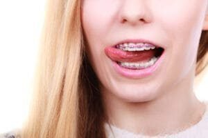 good braces colors