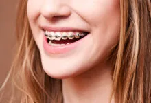 best colors for braces