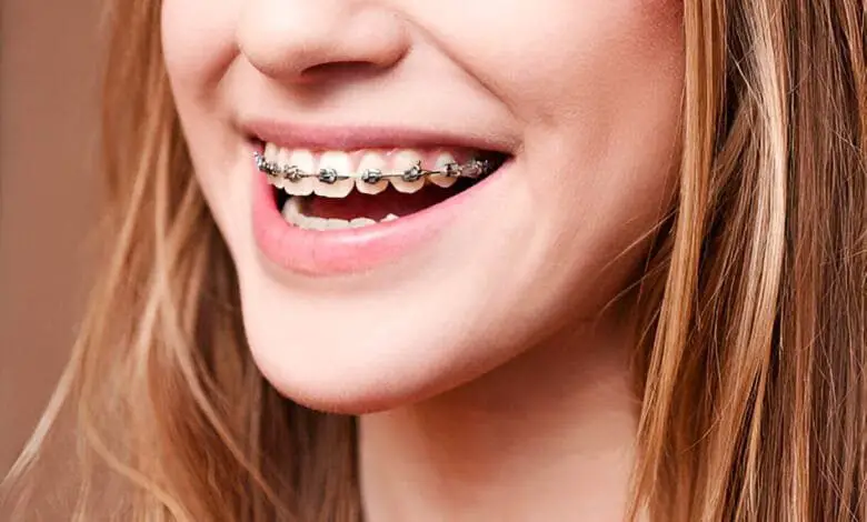 best colors for braces