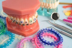 brackets for braces