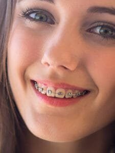 best colors for braces