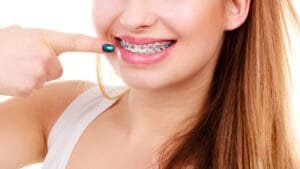 good braces colors