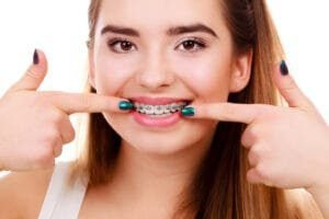 good braces colors