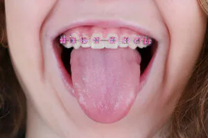 pink color braces