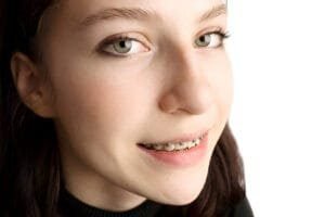 braces colors black