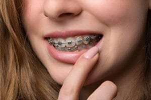 power chain braces