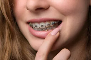 power chain braces