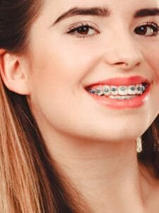 best colors for braces