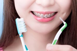 self ligating braces