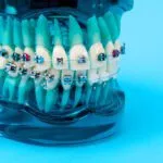 brackets for braces