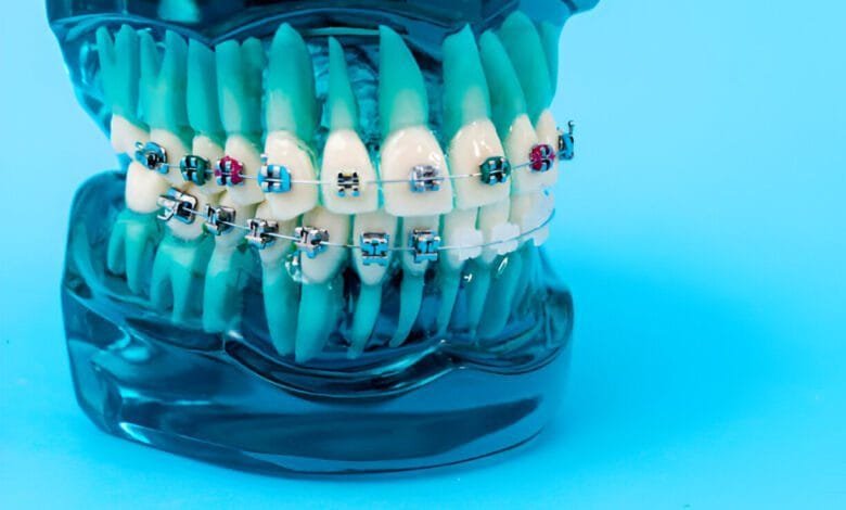 brackets for braces