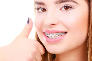 good braces colors