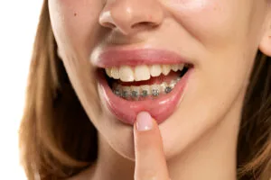 power chain braces