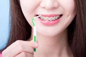 self ligating braces