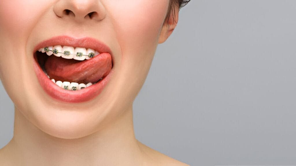 power chain braces