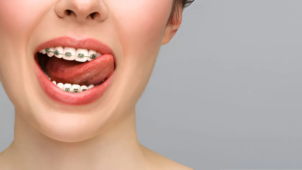 power chain braces