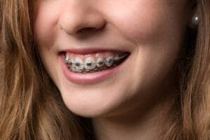 best colors for braces